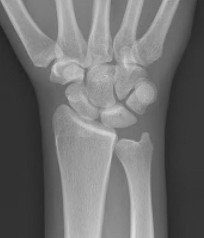ulna neg