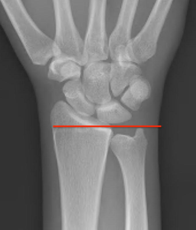 ulna
