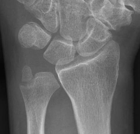 ulna styloid