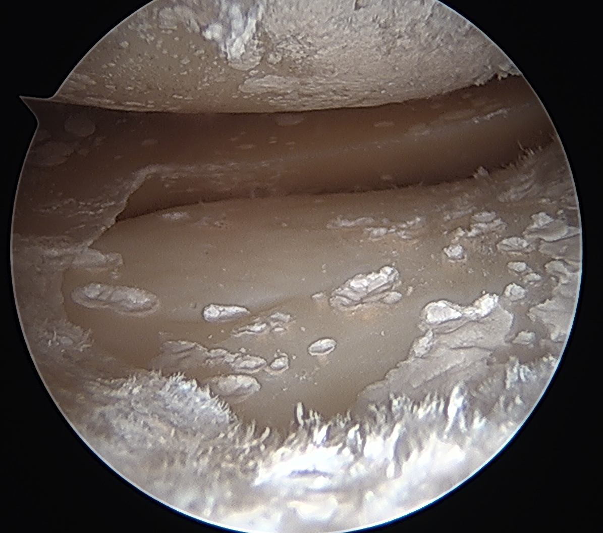 Chondrocalcinosis knee 2