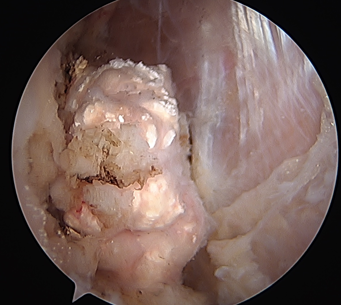 Chondrocalcinosis knee 4