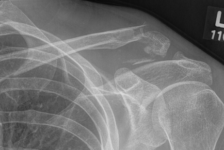 Distal clavical fracture