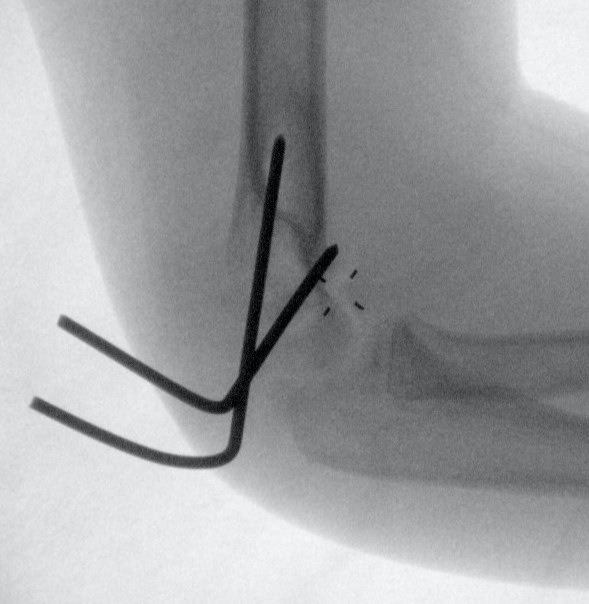 K wires lateral condyle 2