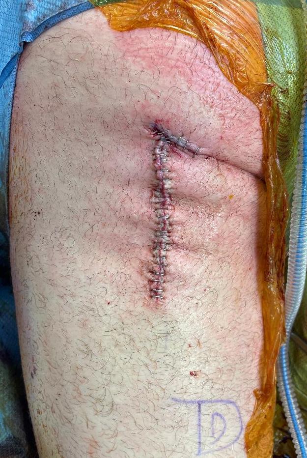 Prox hs incision