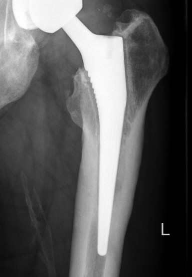 Loosening uncemented stem