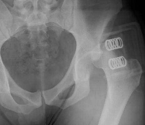 Posterior Hip Dislocation