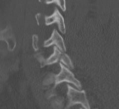 Cervical Spine Facet Fracture