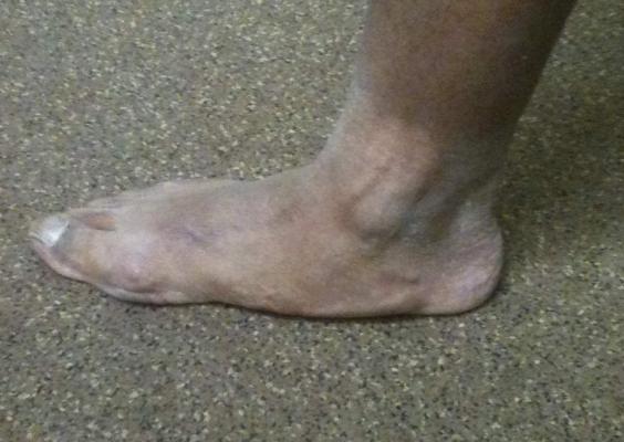 Adult Flatfoot Clinical