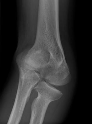 Elbow Cubitus Varus