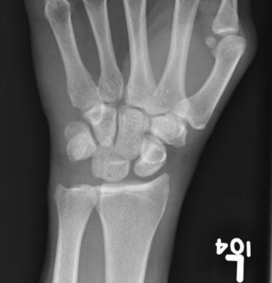 Perilunate Dislocation 1