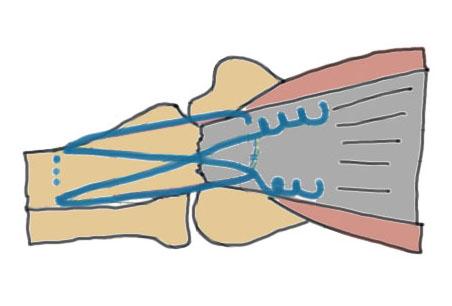 tension suture