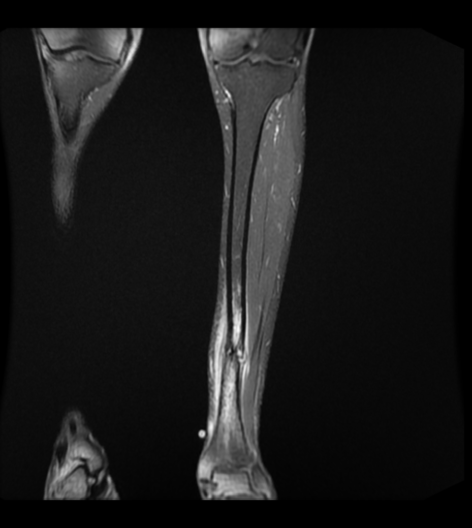 Tibial Stress Fracture
