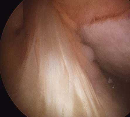 ACL Normal Arthroscopy