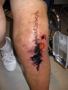 TKR Wound Complication