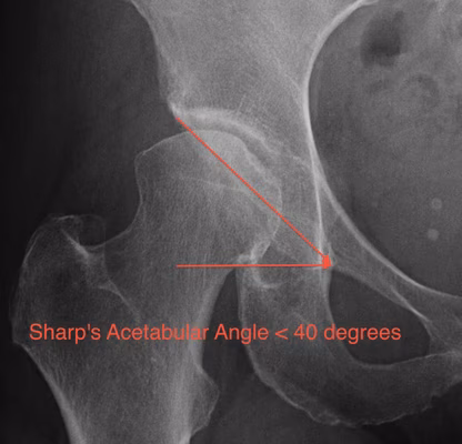 Sharp's Acetabular Angle > 40
