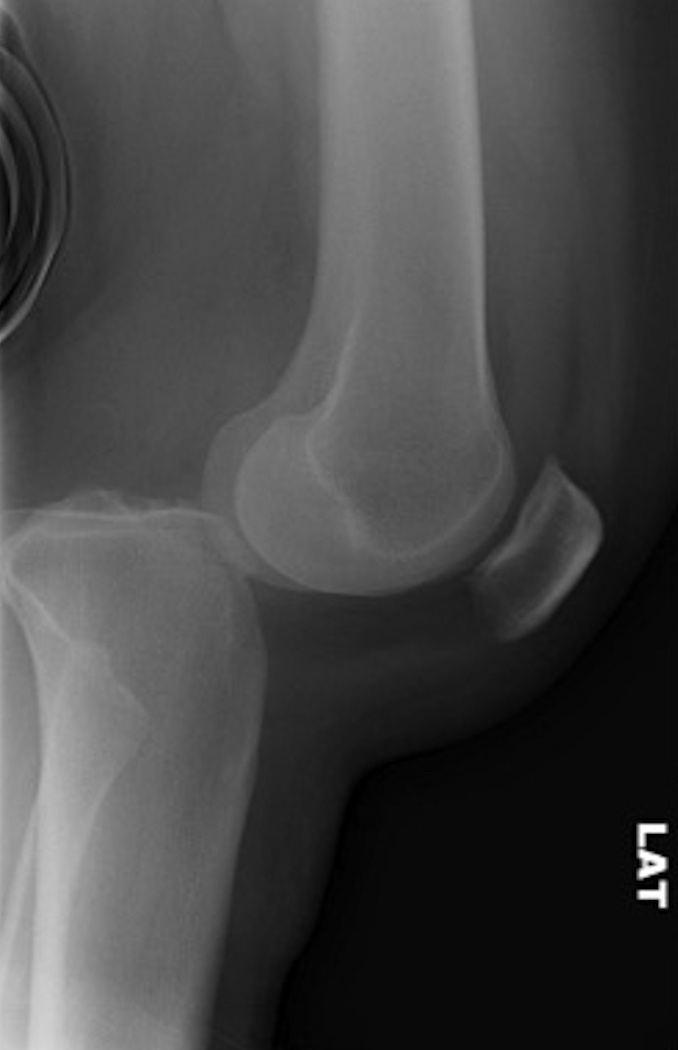 Tibia Dislocation Background | The Bone School