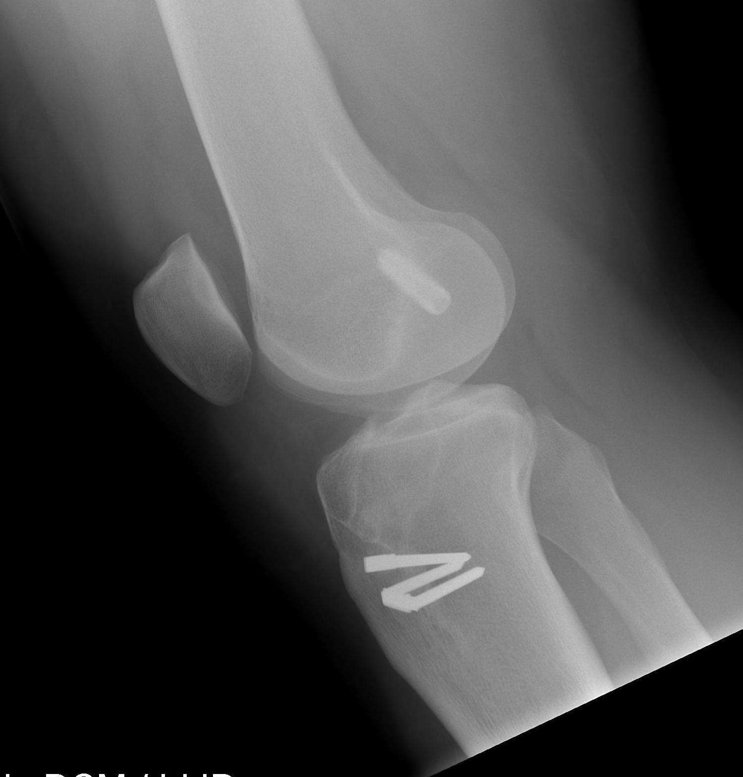 BPTB Allograft | The Bone School
