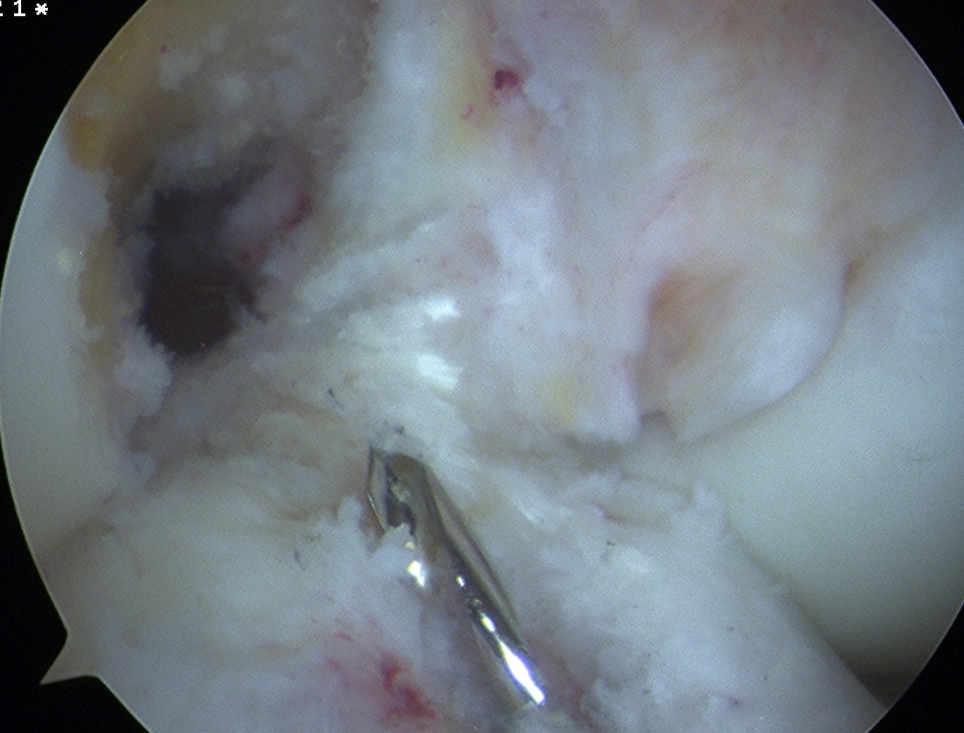 BPTB Autograft | The Bone School