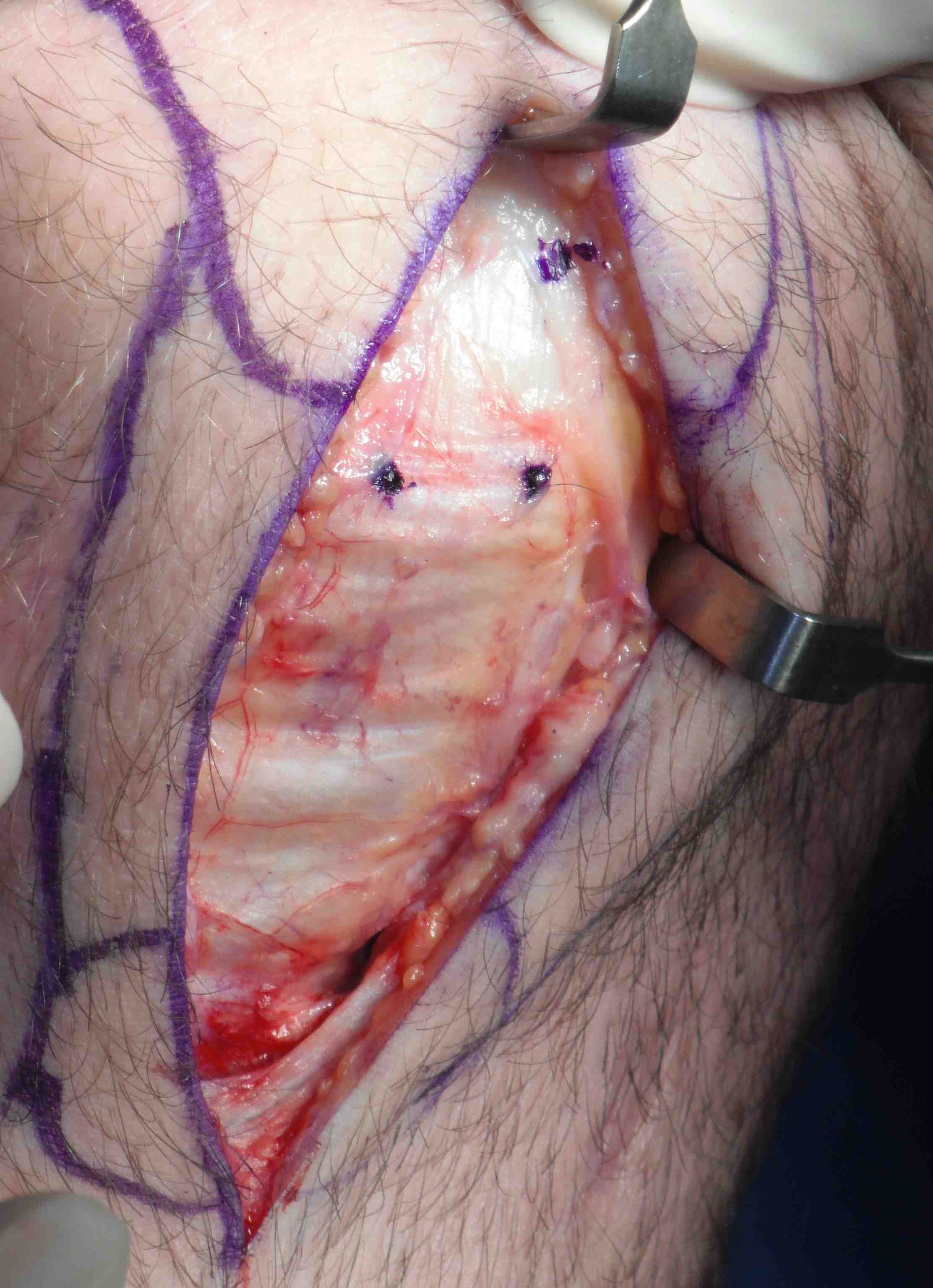BPTB Autograft | The Bone School