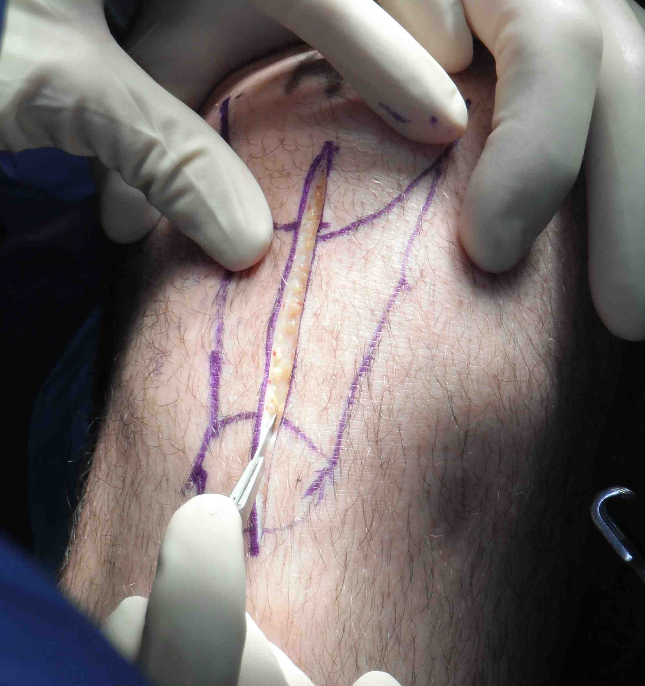 BPTB Autograft | The Bone School