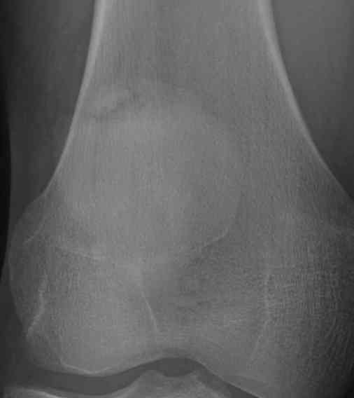 Bipartite Patella | The Bone School