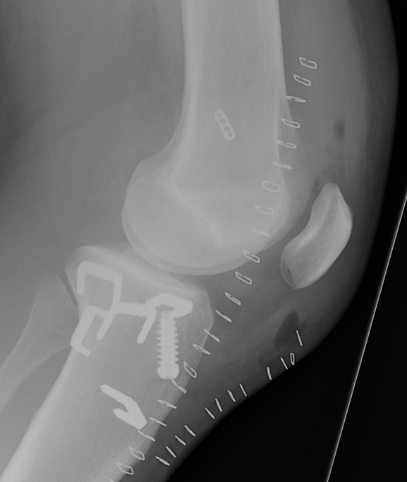Hamstring Acl Device Surgical management | The Bone School