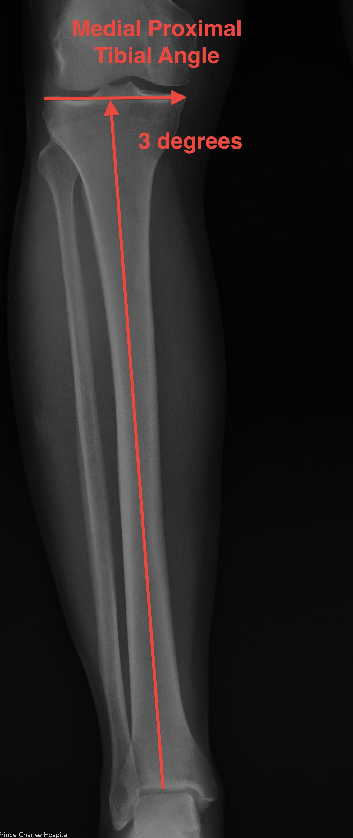 Tibia Angulation Lower Limb Alignment | The Bone School