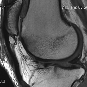 Patellar tendonitis