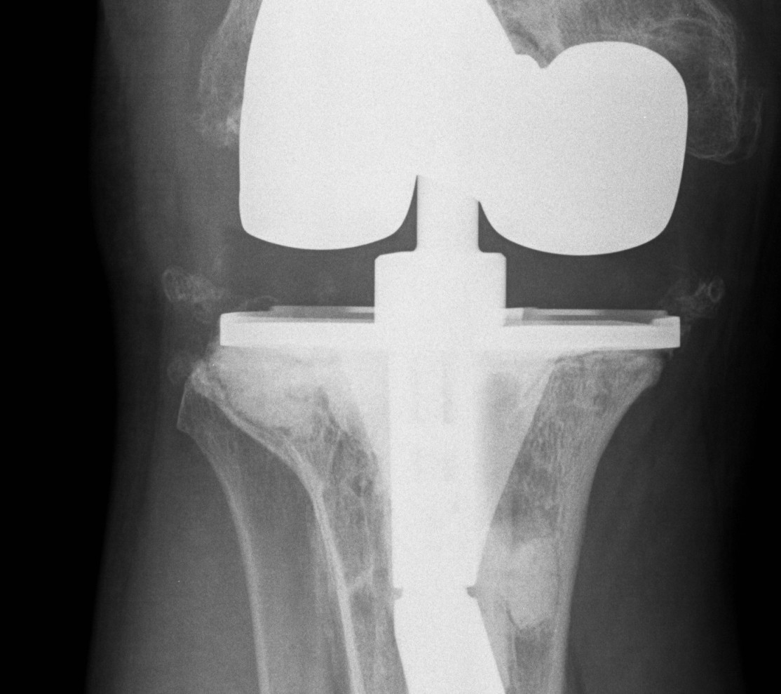 Management Bone Defects | The Bone School