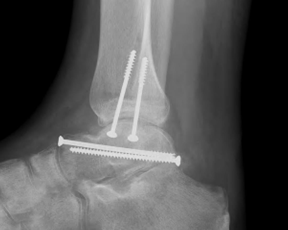 Talar body fracture | The Bone School