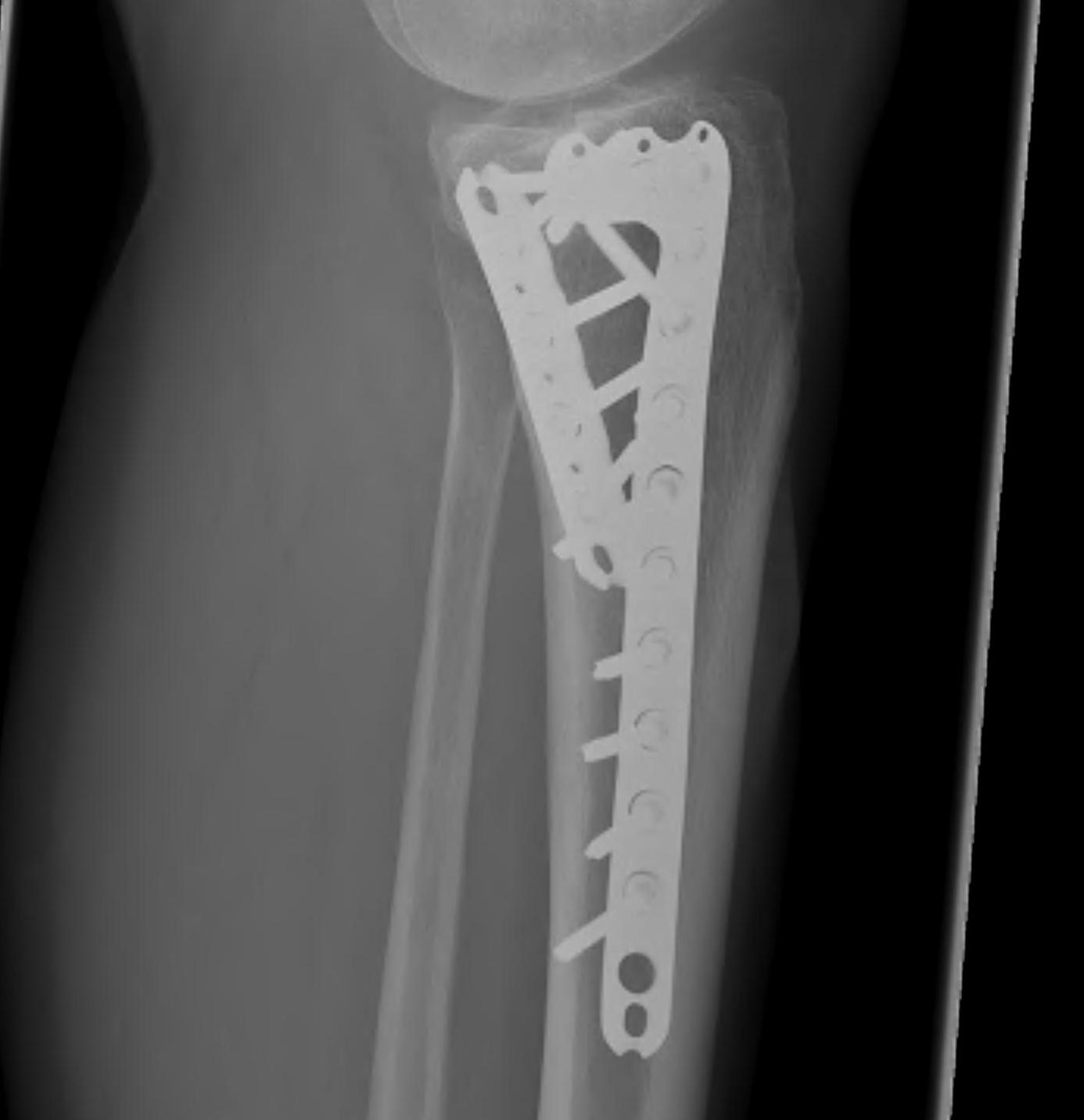 Tibial Plateau | The Bone School