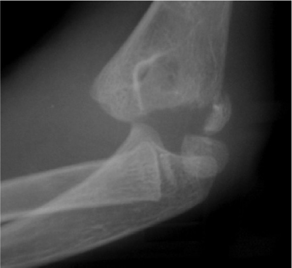 Distal humeral physeal separation | The Bone School