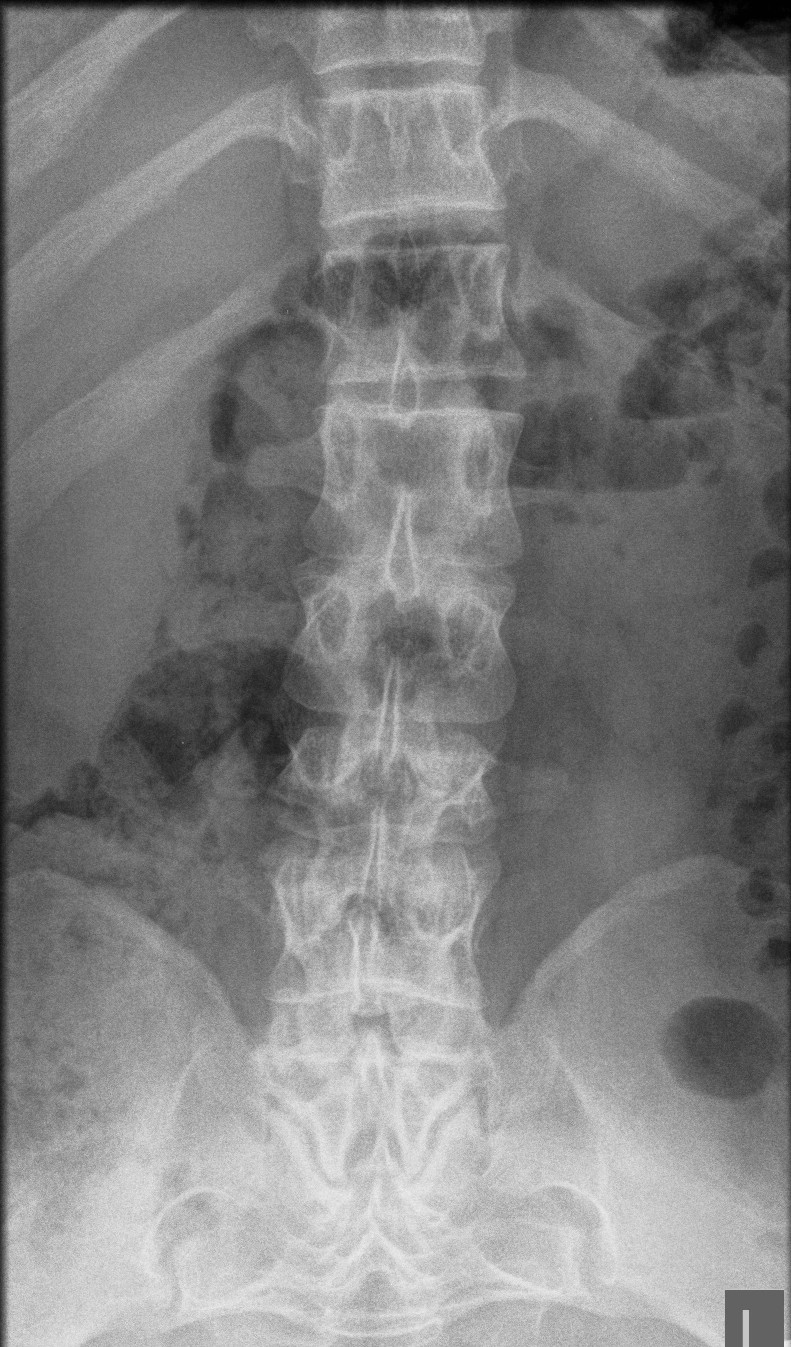 Achondroplasia | The Bone School