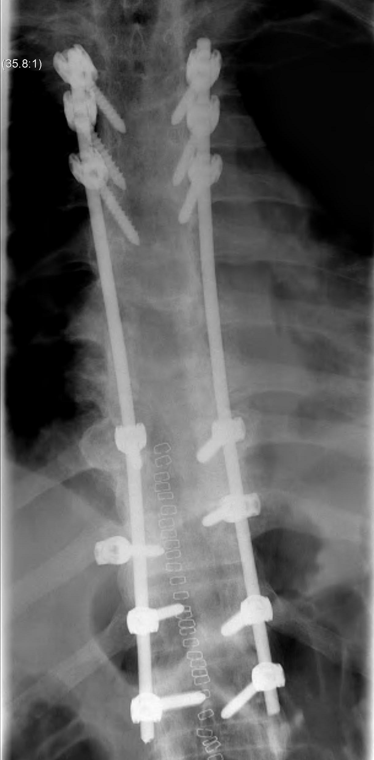 Ankylosing Spondylitis | The Bone School