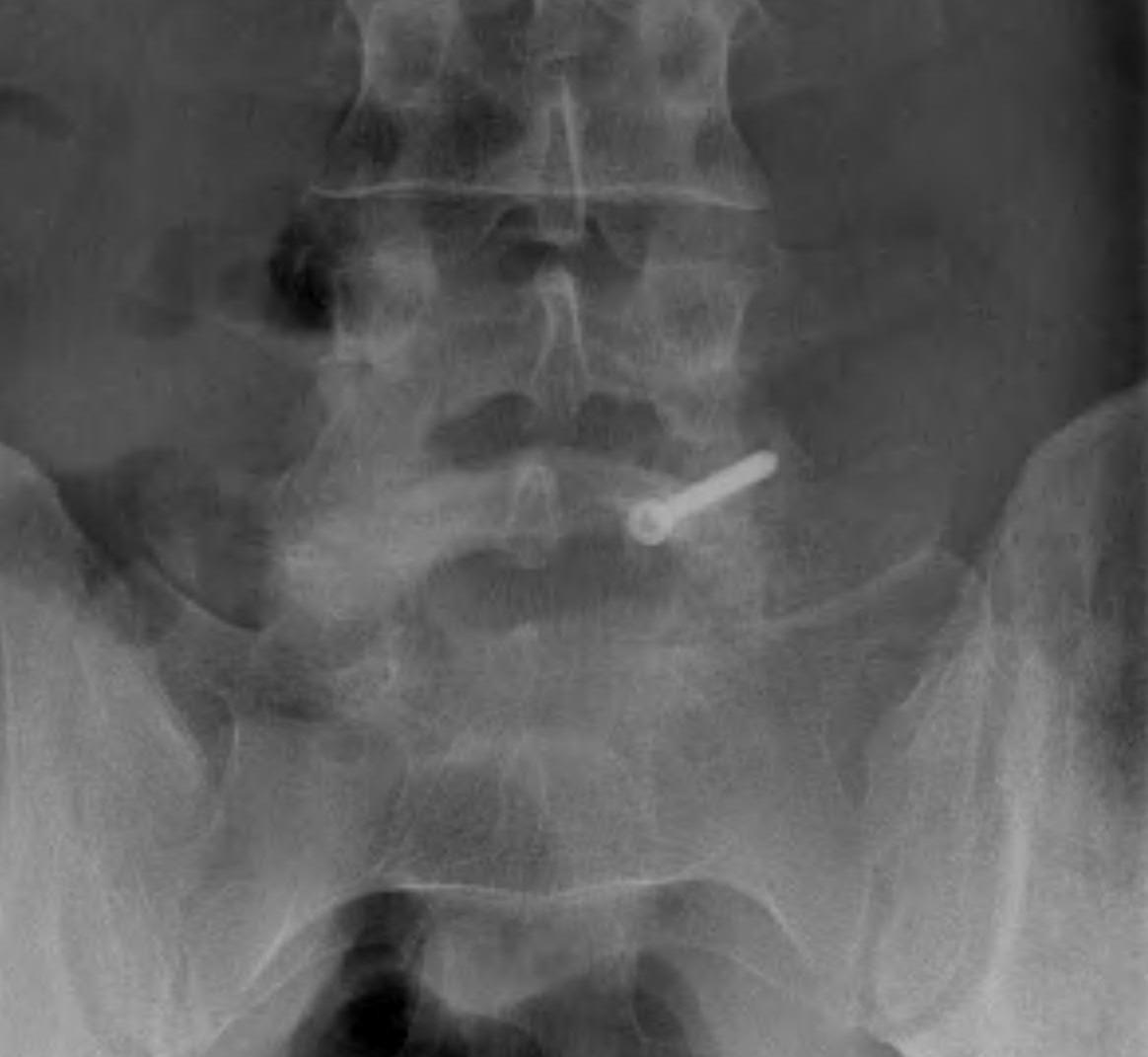 Pars Defect Decompression Spondylolisthesis Dyplastic Isthmic | The Bone School