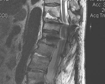 Postoperative discitis | The Bone School
