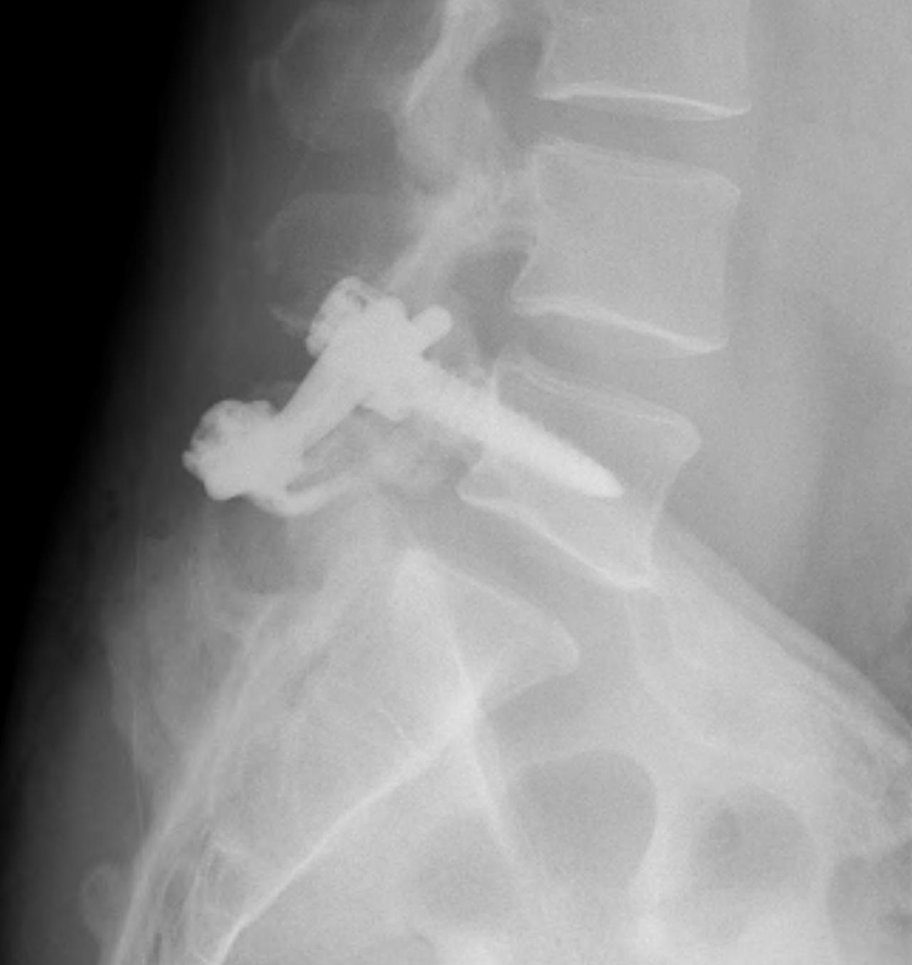 Pars Defect Block Spondylolisthesis Dyplastic Isthmic | The Bone School