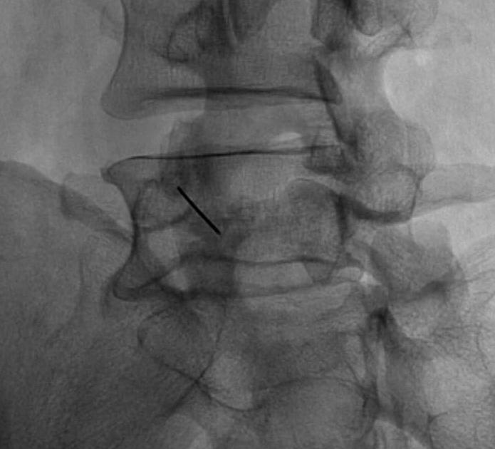 Pars Inj Spondylolisthesis Dyplastic Isthmic | The Bone School