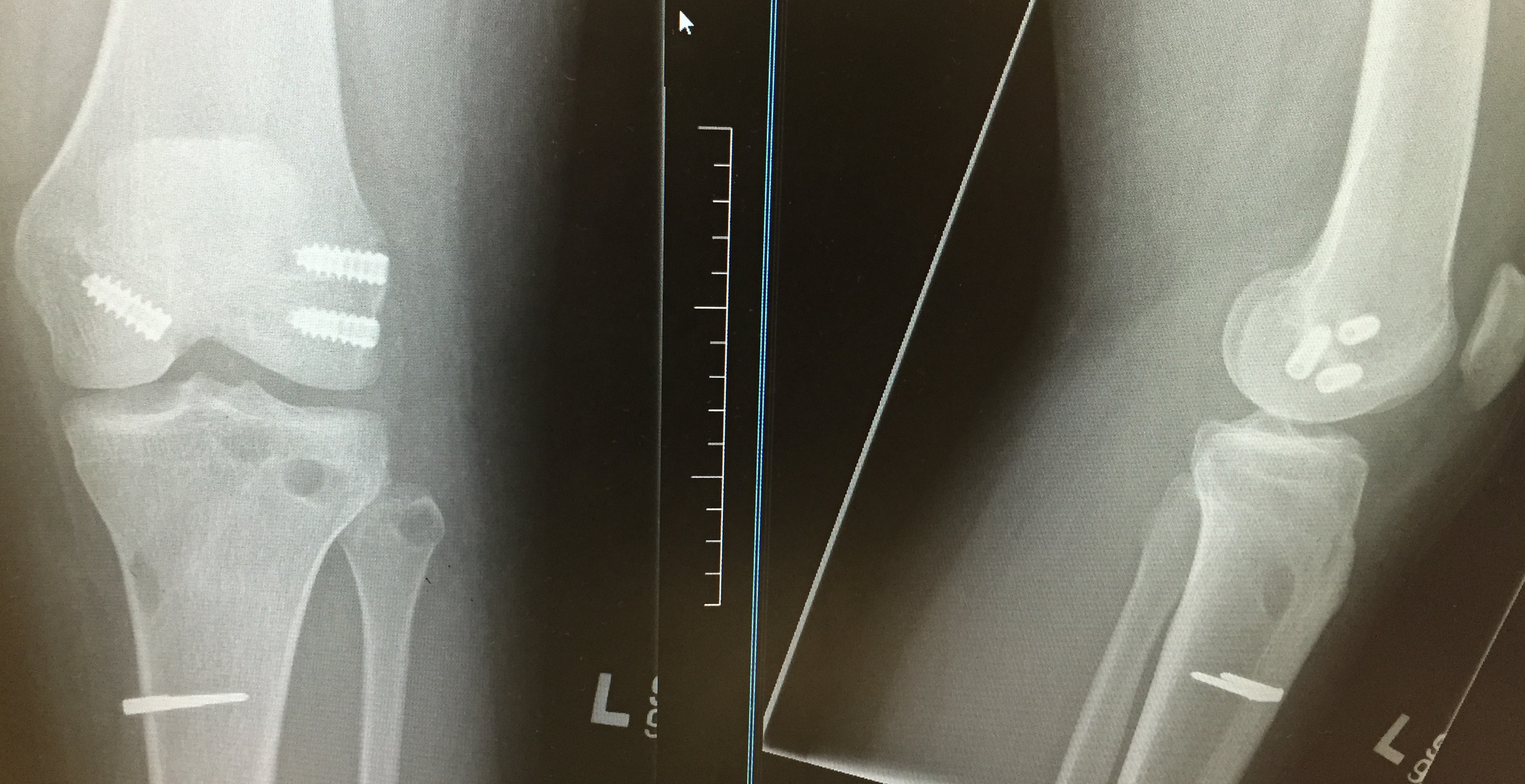 Technique ACL PCL Posterolateral Corner | The Bone School