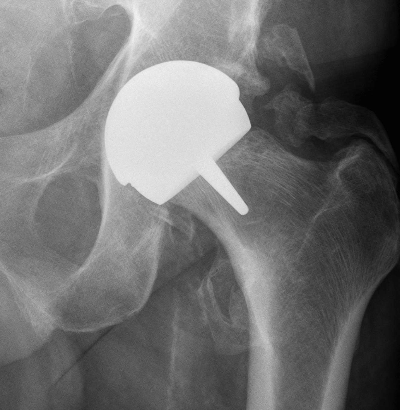 Resurfacing | The Bone School