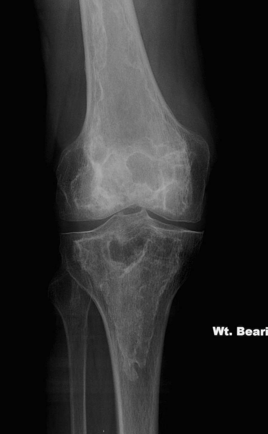 bone infarct | The Bone School