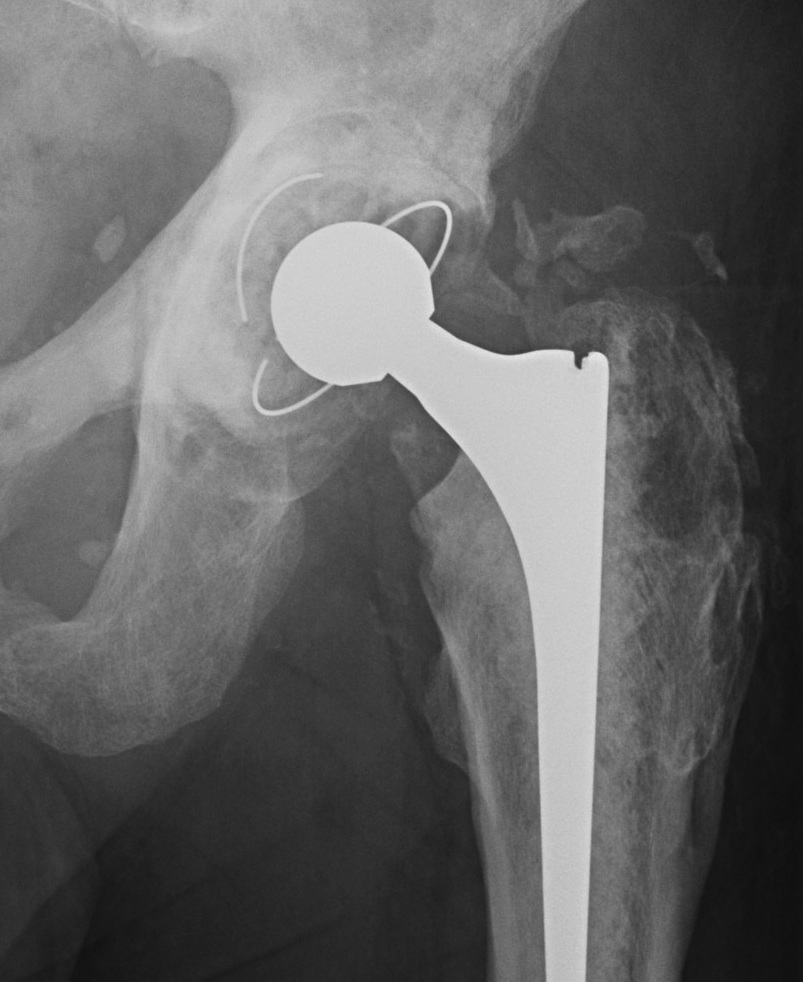Heterotopic Ossification | The Bone School