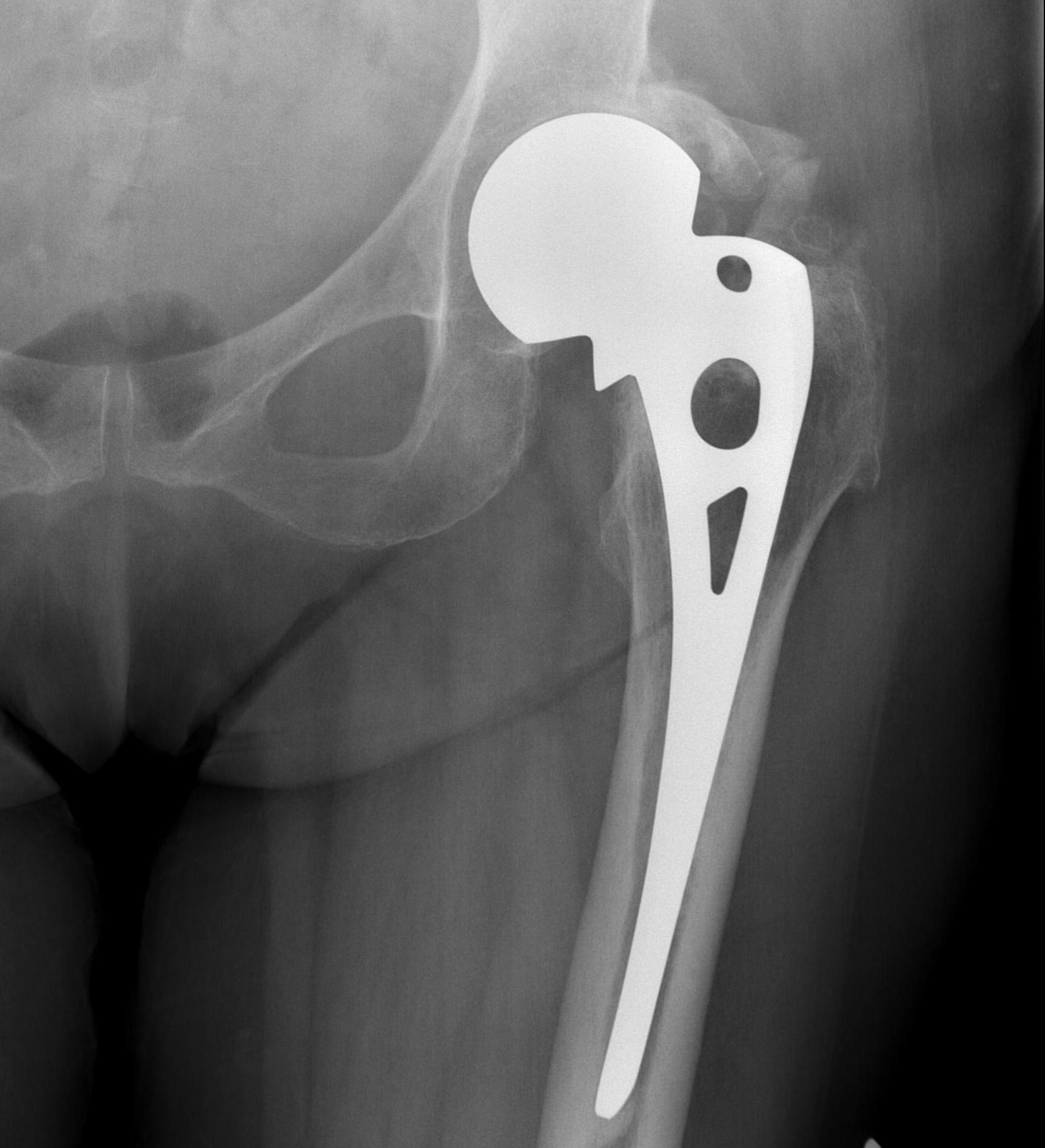 Arthroplasty | The Bone School