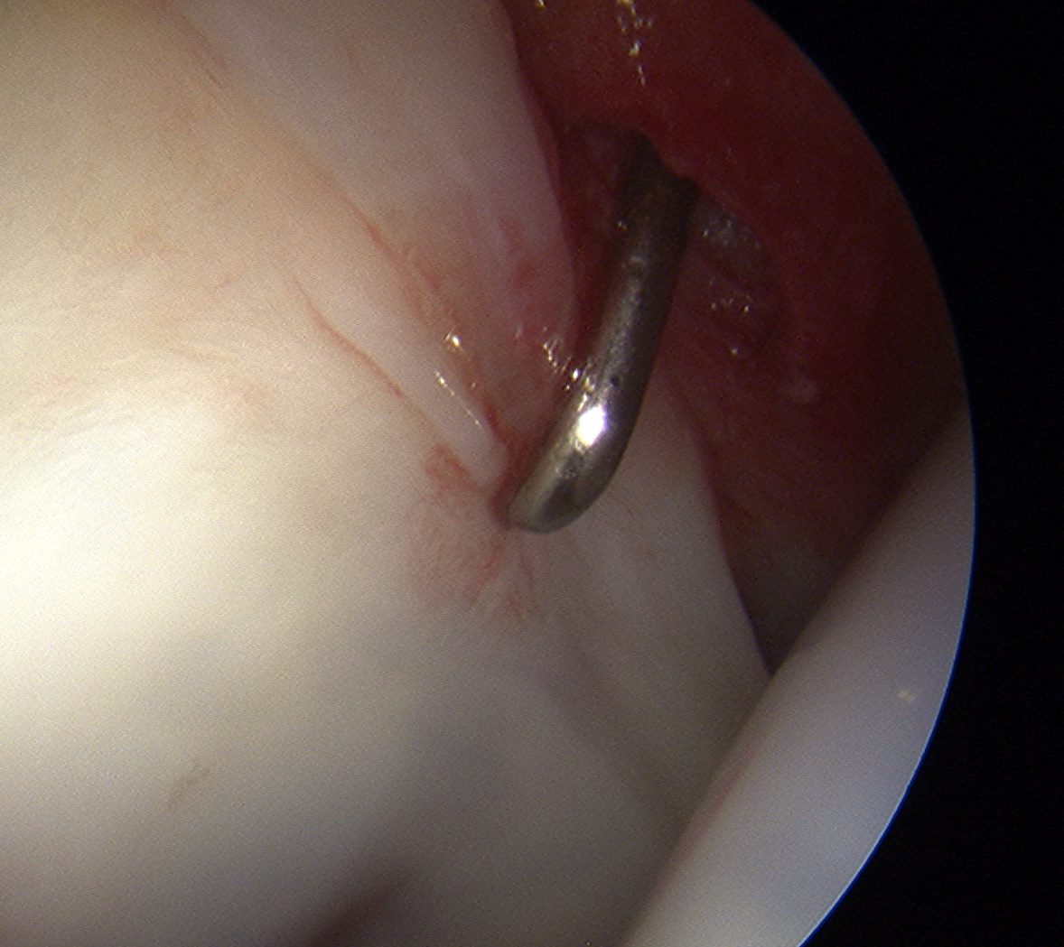 Hip Arthroscopy | The Bone School