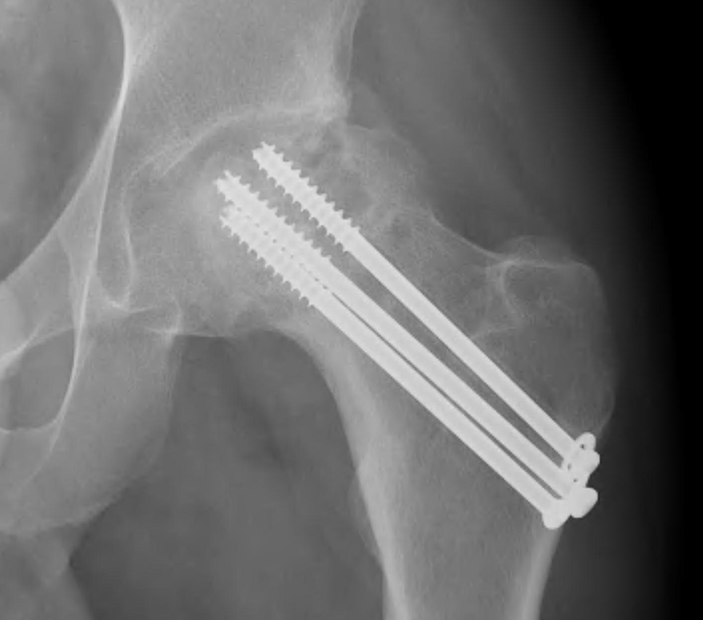 Fixation | The Bone School