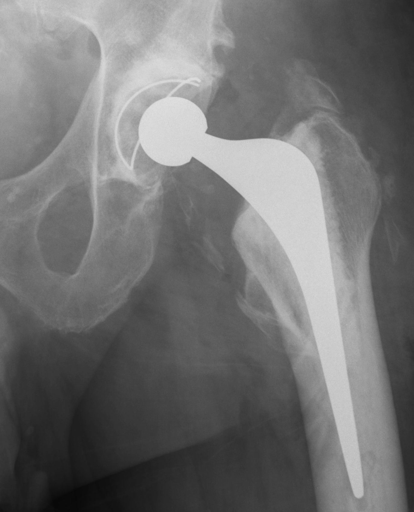 Heterotopic Ossification | The Bone School