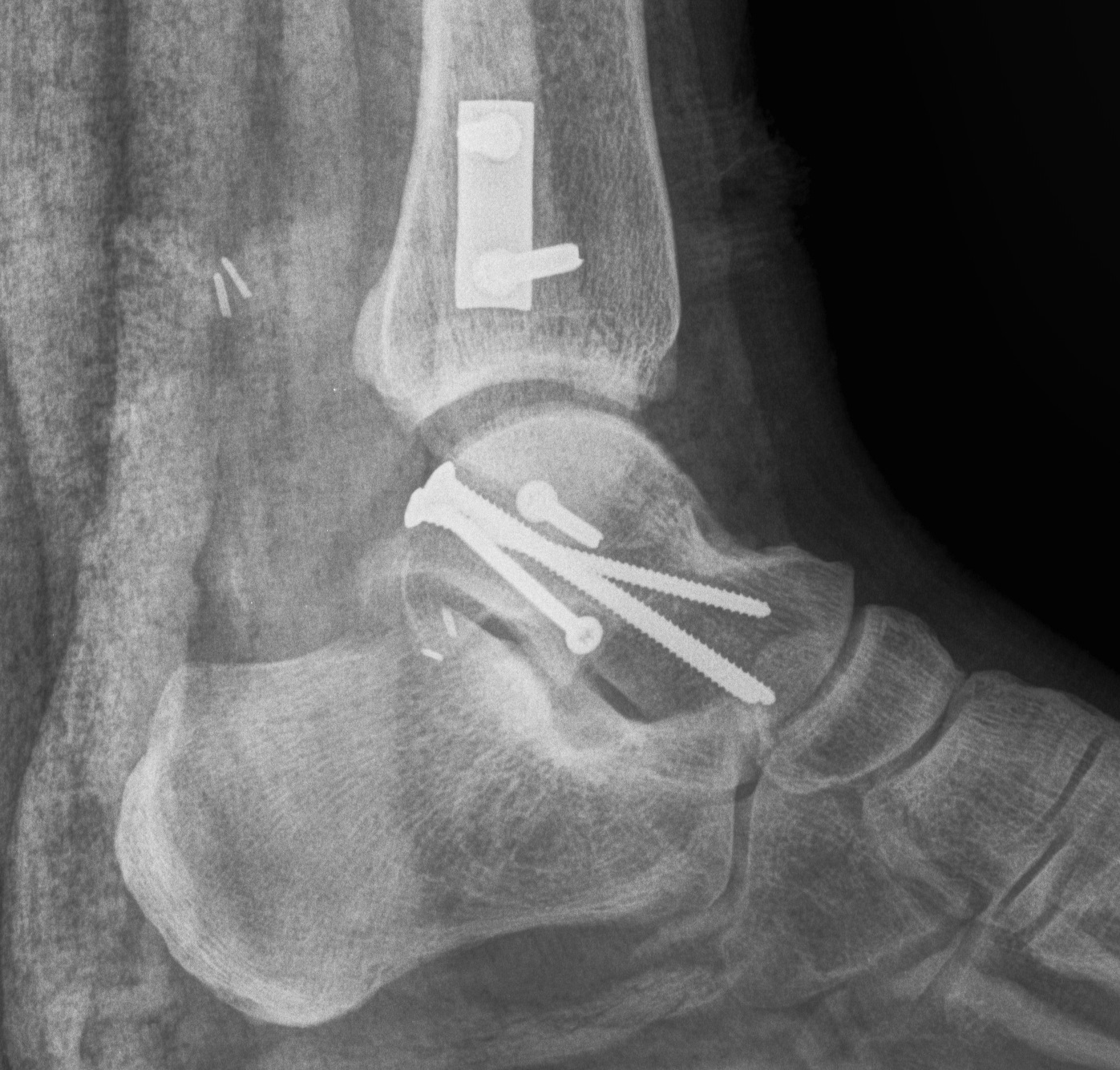 Talar neck fractures | The Bone School
