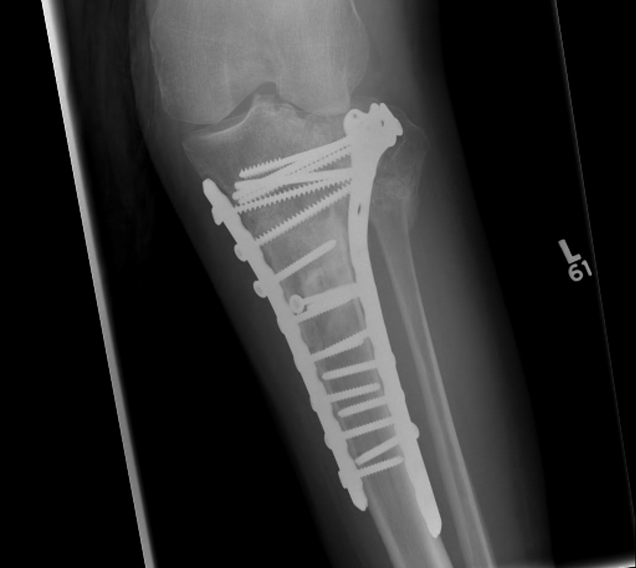 Tibial Plateau | The Bone School