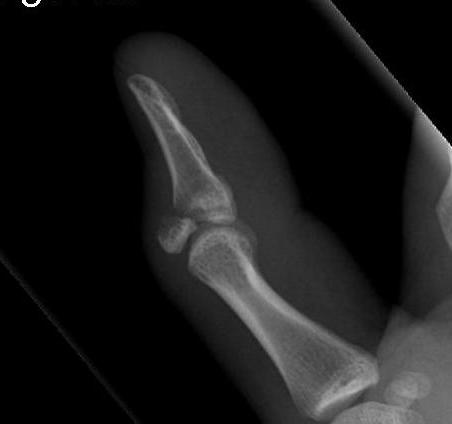 Mallet finger | The Bone School