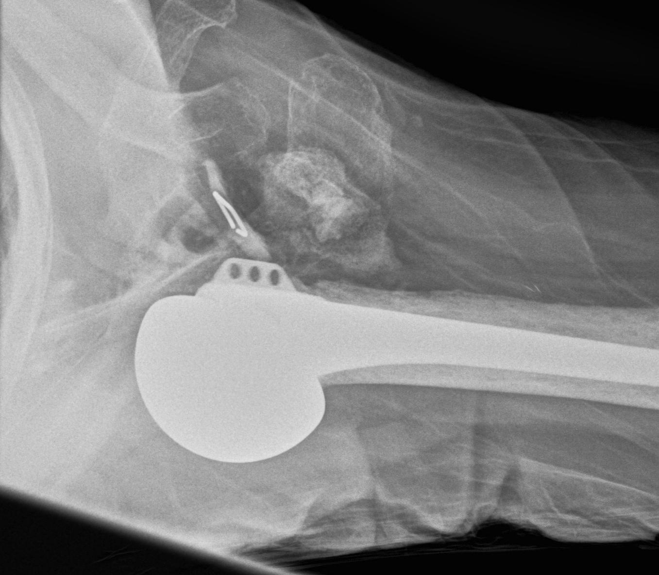 Tow Dislocation Complications | The Bone School
